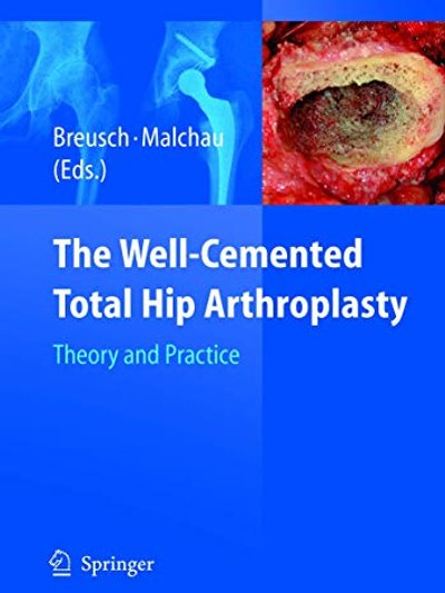 The Well-Cemented Total Hip Arthroplasty: Theory and Practice
